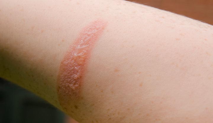 Beneficios del Colágeno Natural de Colway para el Cuidado y Curación de Quemaduras