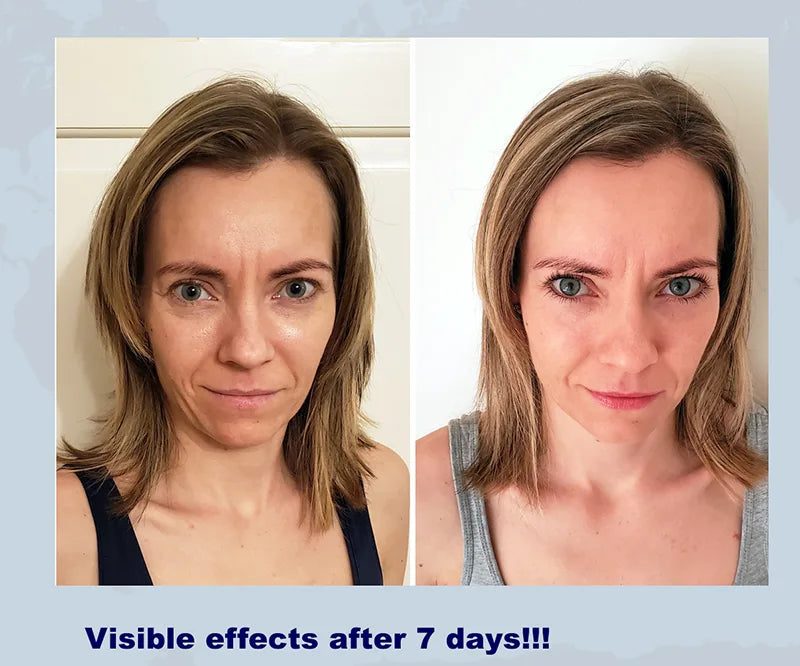 Introducción al lifting facial sin cirugía con las ampollas Spectrum de Colway