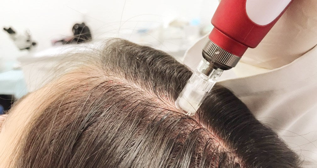 Introducción al Dermapen capilar