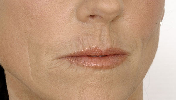 Una Guía Completa para Entender y Tratar las Arrugas de Código de Barras en la Parte Superior de los Labios