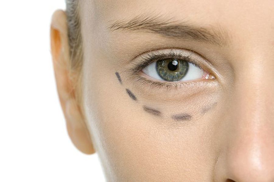 Eliminación y Prevención de Ojeras: Guía Completa y Tratamientos Profesionales