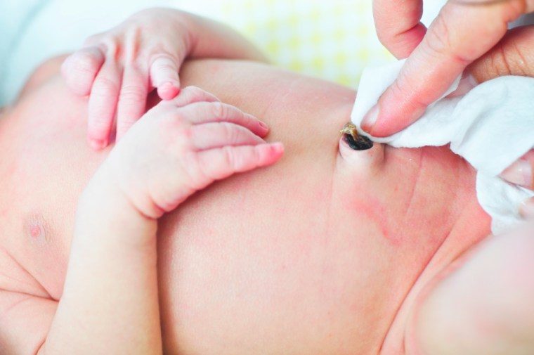 Meliquet: Cuidado Revolucionario y Seguro para el Ombligo de los Recién Nacidos