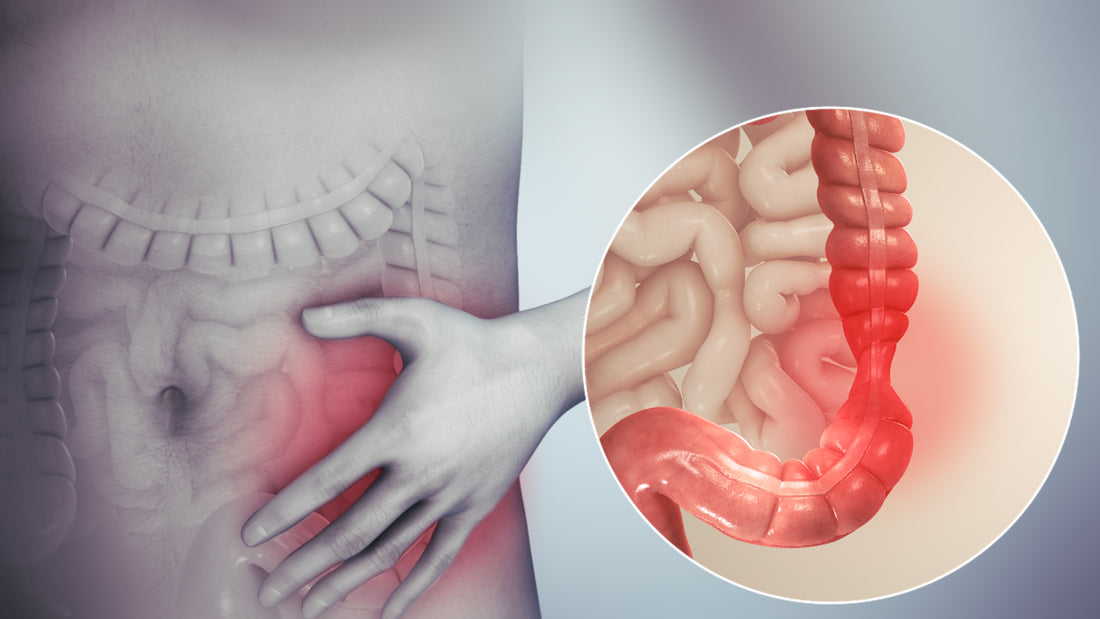 Desvelando los secretos de Synbiocol: una solución revolucionaria para el síndrome del intestino irritable
