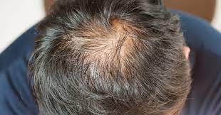 Latanoprost: un enfoque novedoso para combatir la alopecia androgénica