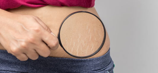 Stretch Marks: A Comprehensive Guide to Understanding and Prevention