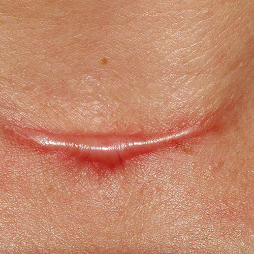 Cicatriz Hipertrófica, ¿qué es?