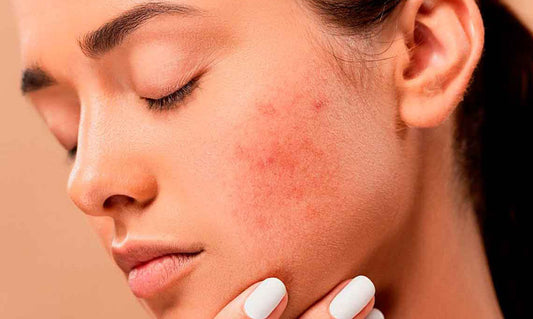 Dermatitis atópica: ¿cómo aliviar y tratar esta inflamación?