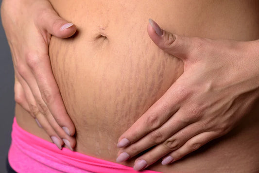 Prevención y Tratamiento de Estrías Durante y Después del Embarazo