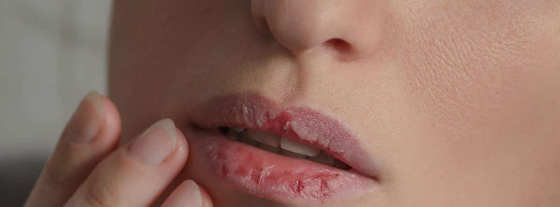 ¿Qué es la Queilitis? Una guía completa para el cuidado de los labios agrietados