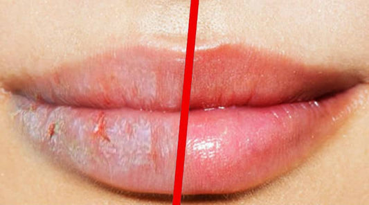 Labios agrietados que no curan: ¿Qué hacer y cómo tratarlos?